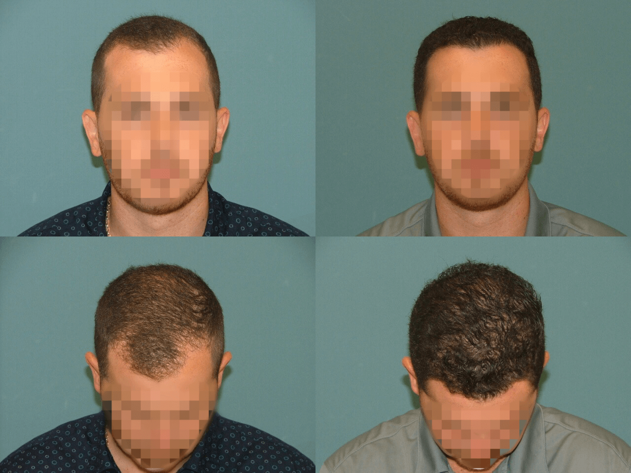 Hair Restoration Before and After