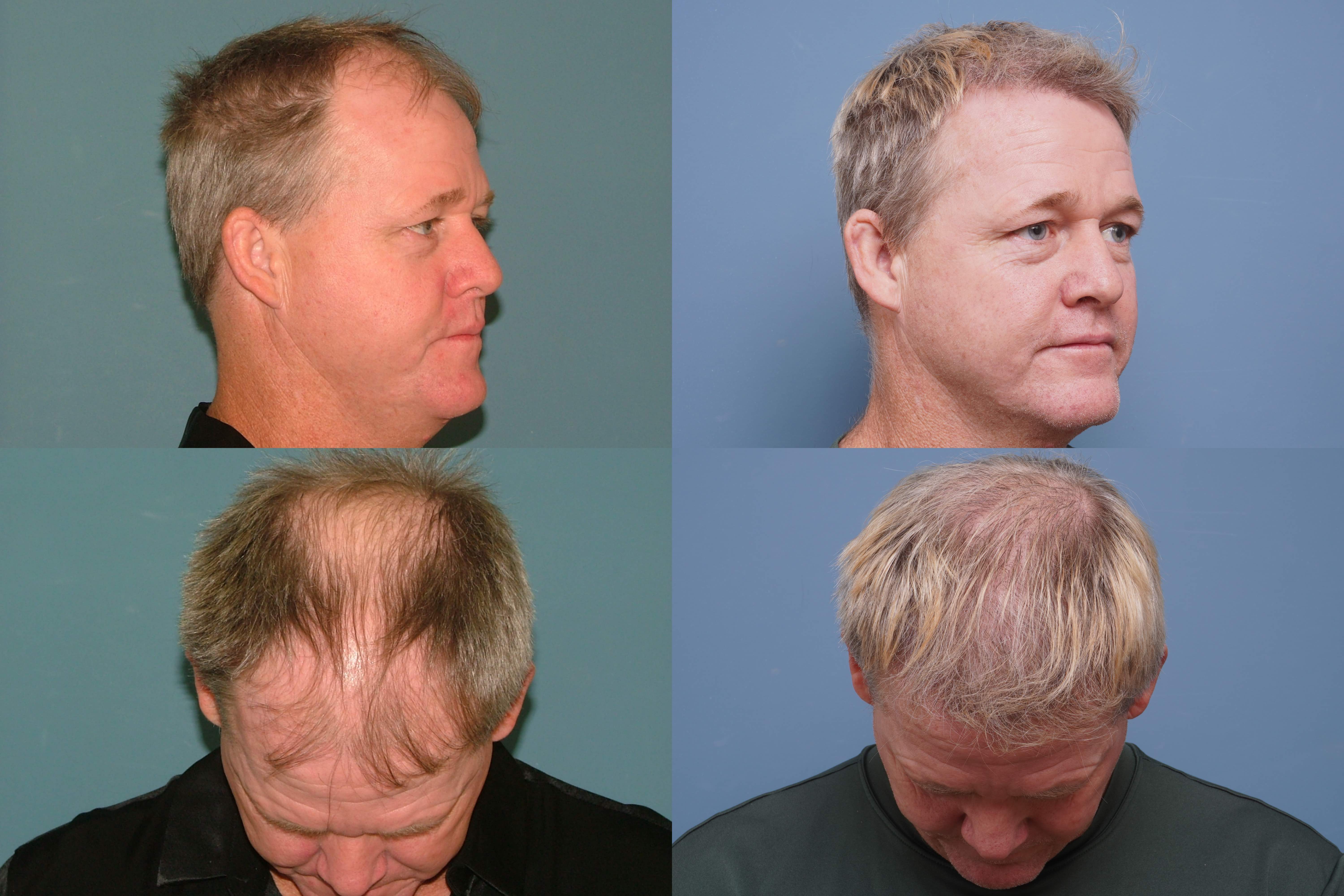 Hair Restoration Before and After
