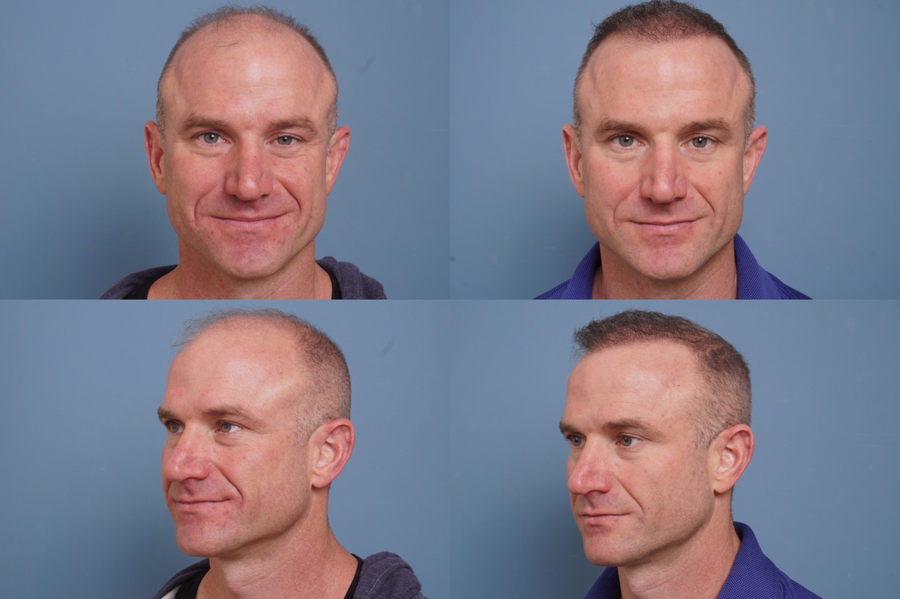 Neograft before and after hair restoration