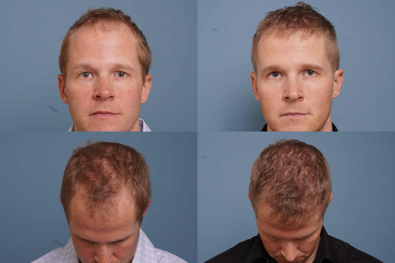 Neograft before and after hair restoration