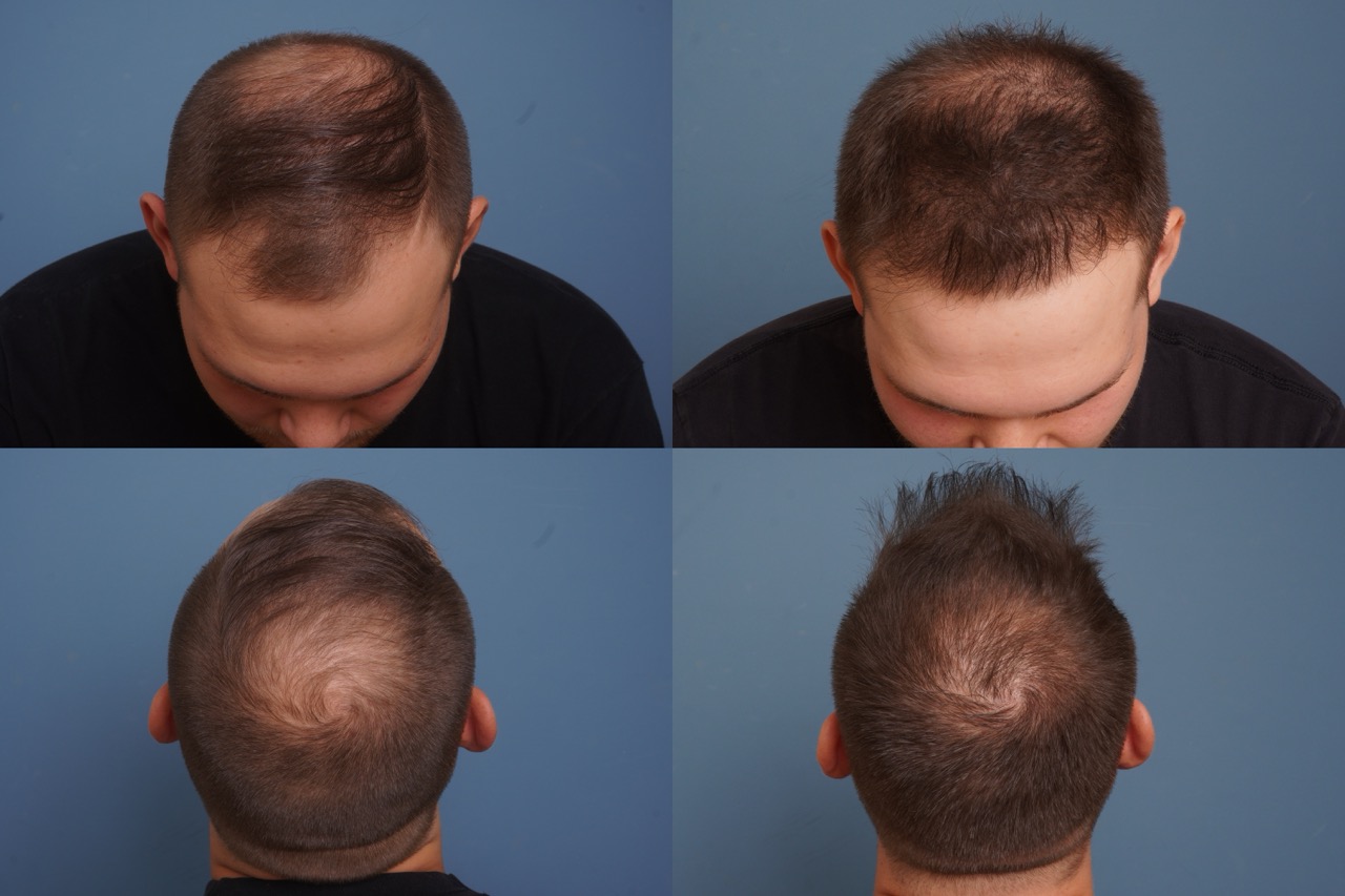 Neograft before and after hair restoration