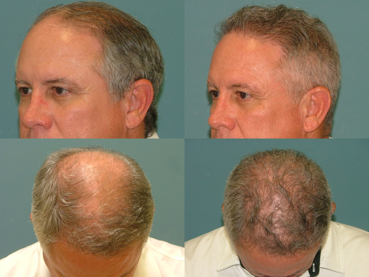 Hair Restoration Before and After