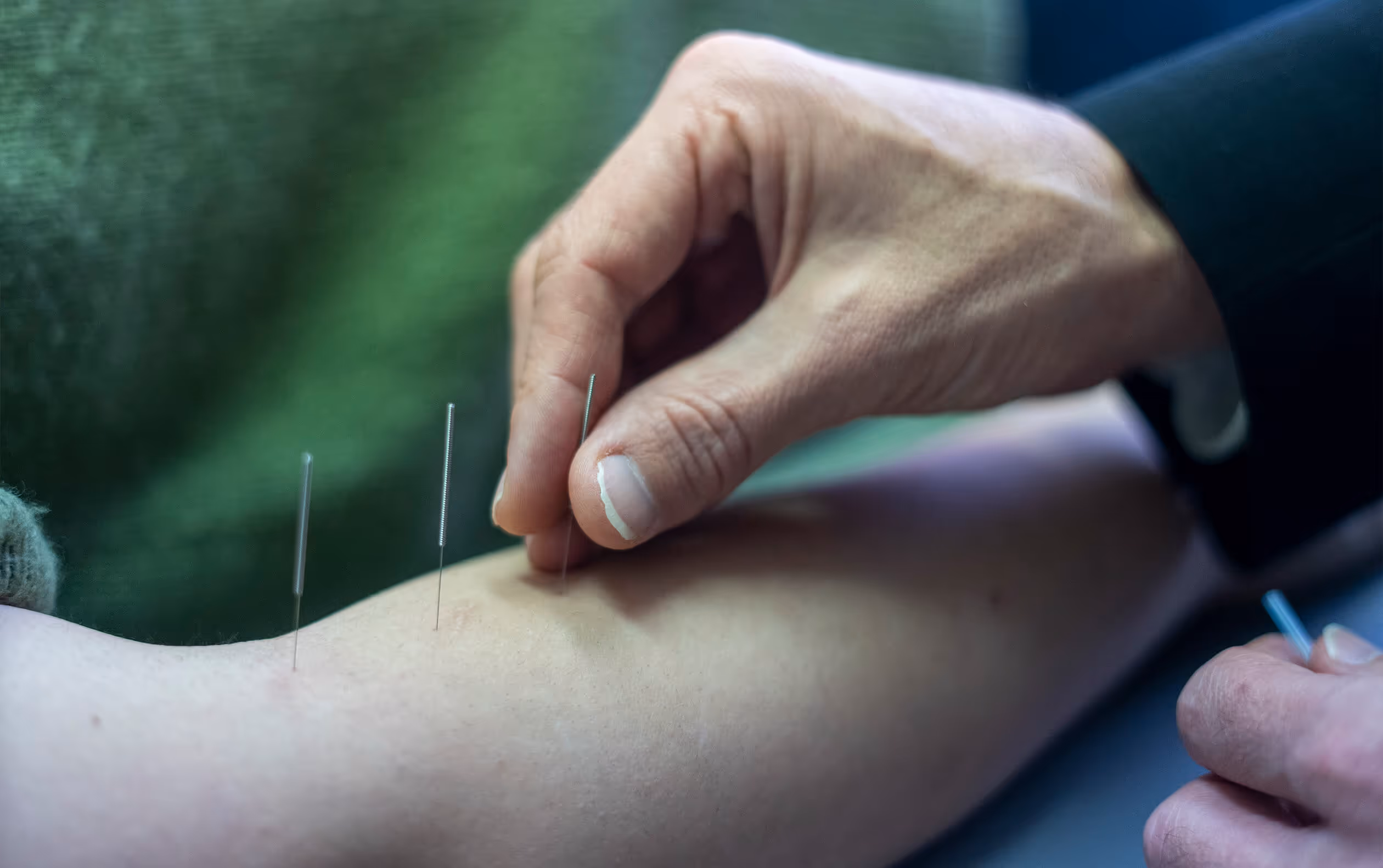 Hand inserting acupuncture needles into a person's forearm during a treatment session.
