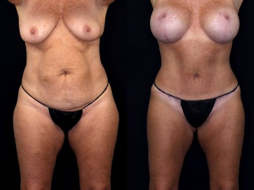 Before And After Patient Image