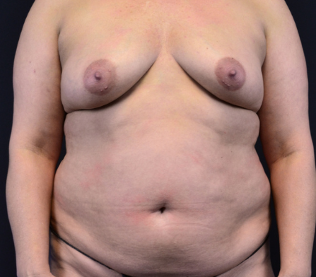 tummy tuck, liposuction and breast augmentation 5 months po 