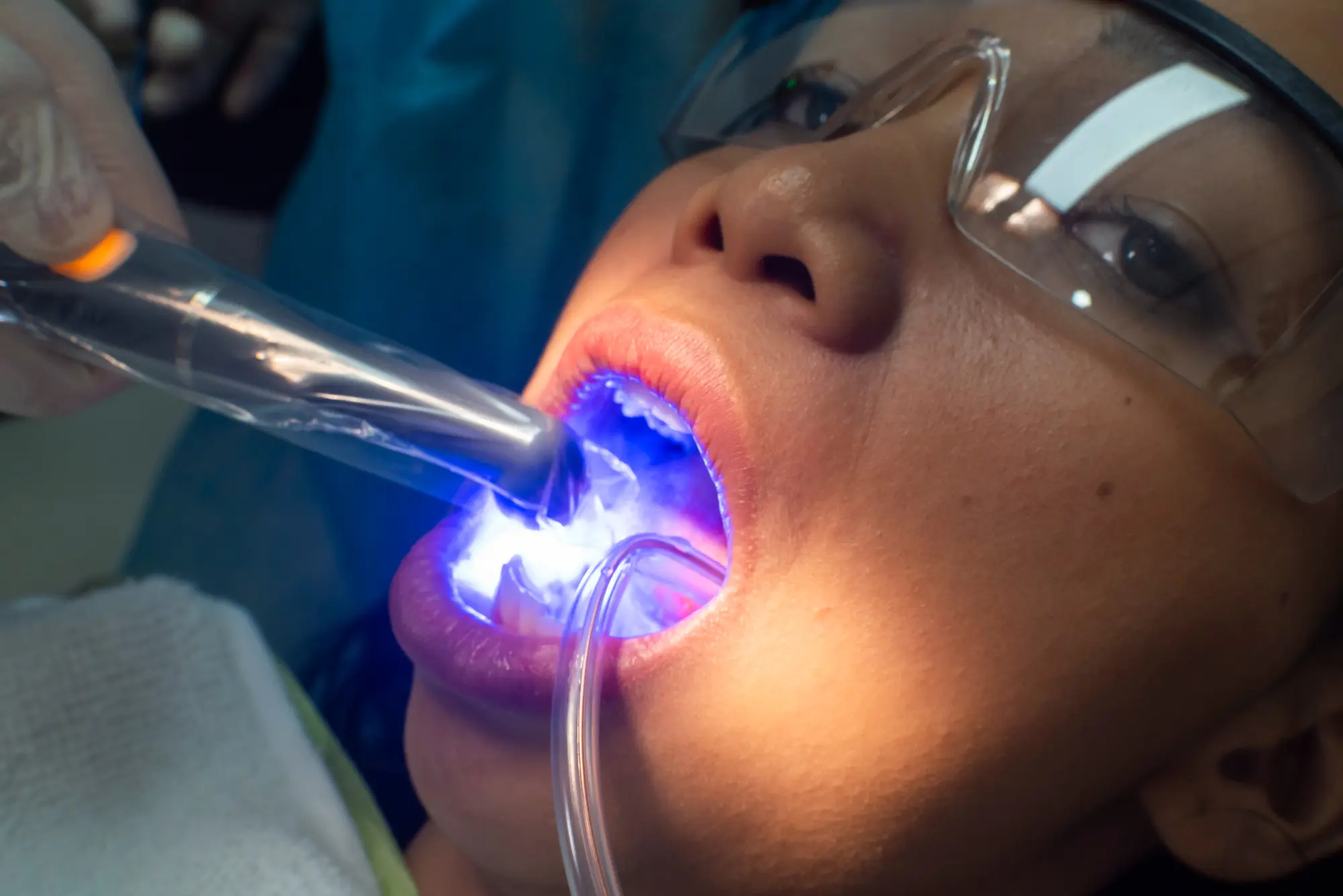 Dental Bonding