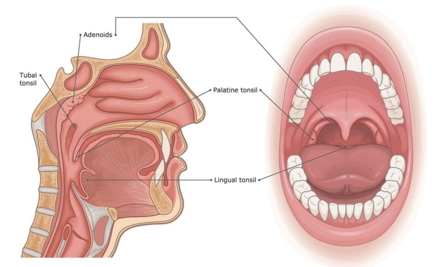 Alternatives to Tonsil and Adenoid Removal: The Role of Skeletal Expansion