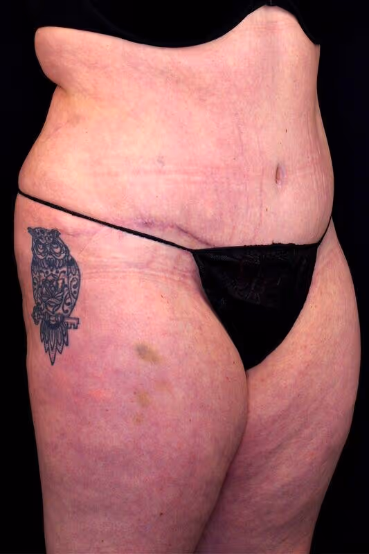 Before And After Patient Image