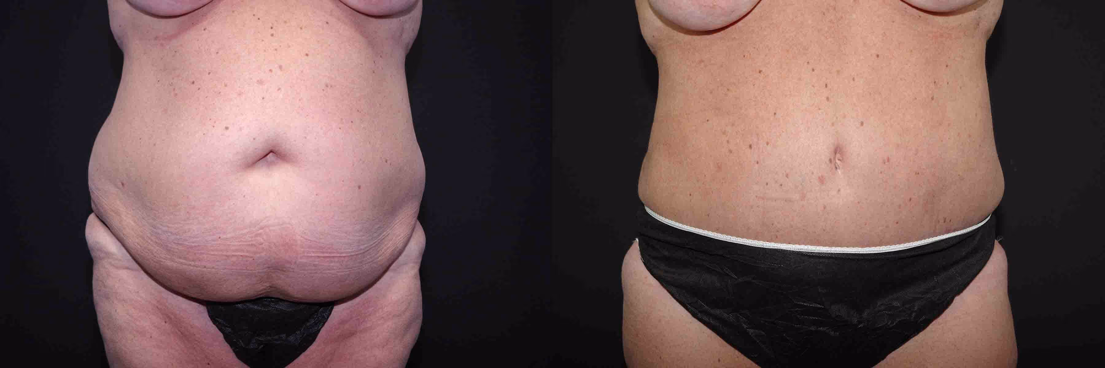 Before And After Patient Image