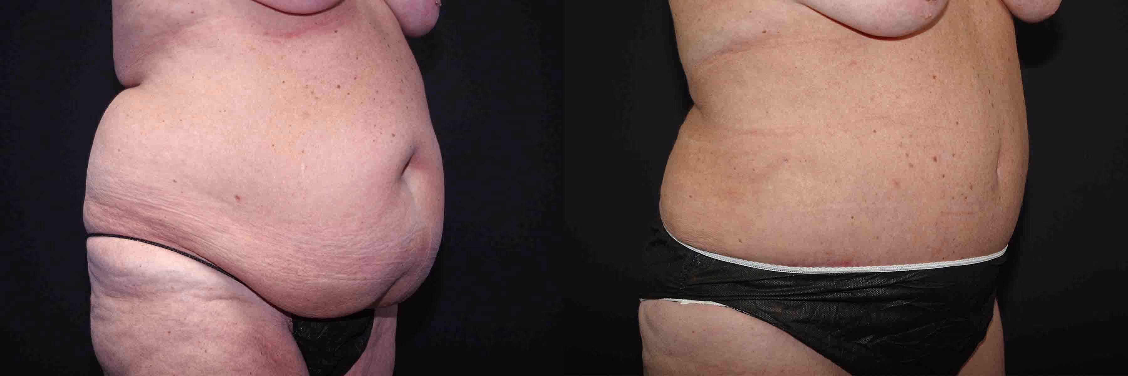 Before And After Patient Image
