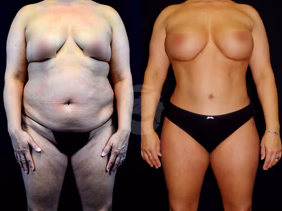 Before And After Patient Image