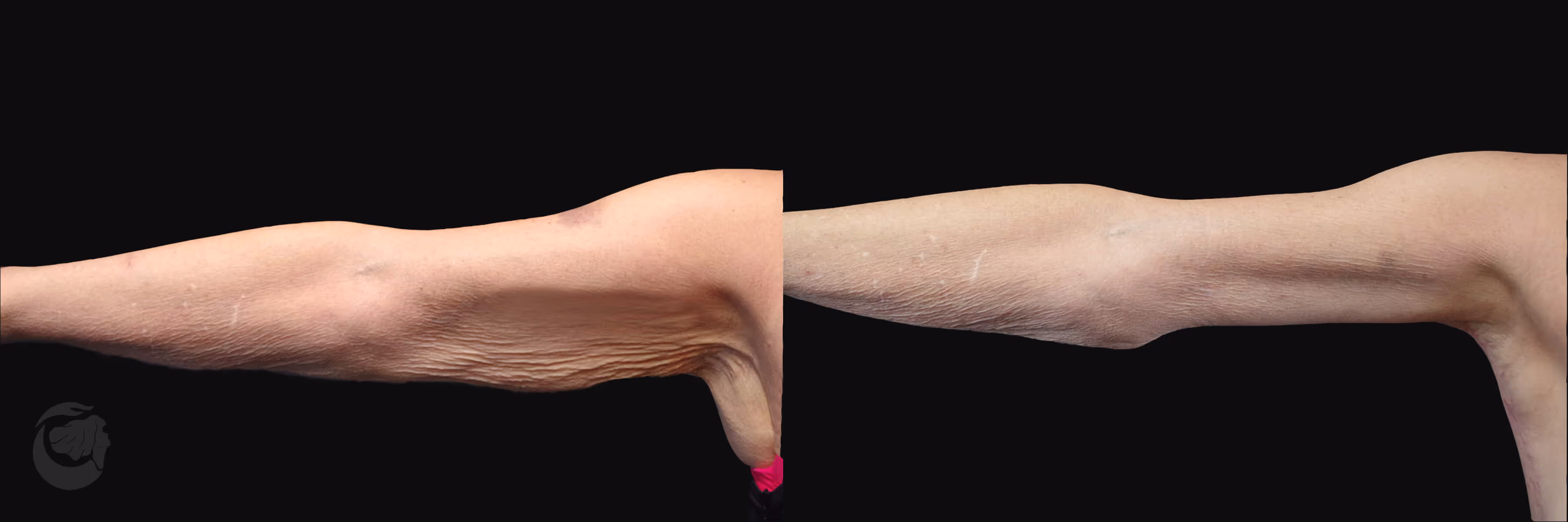 Before And After Patient Image