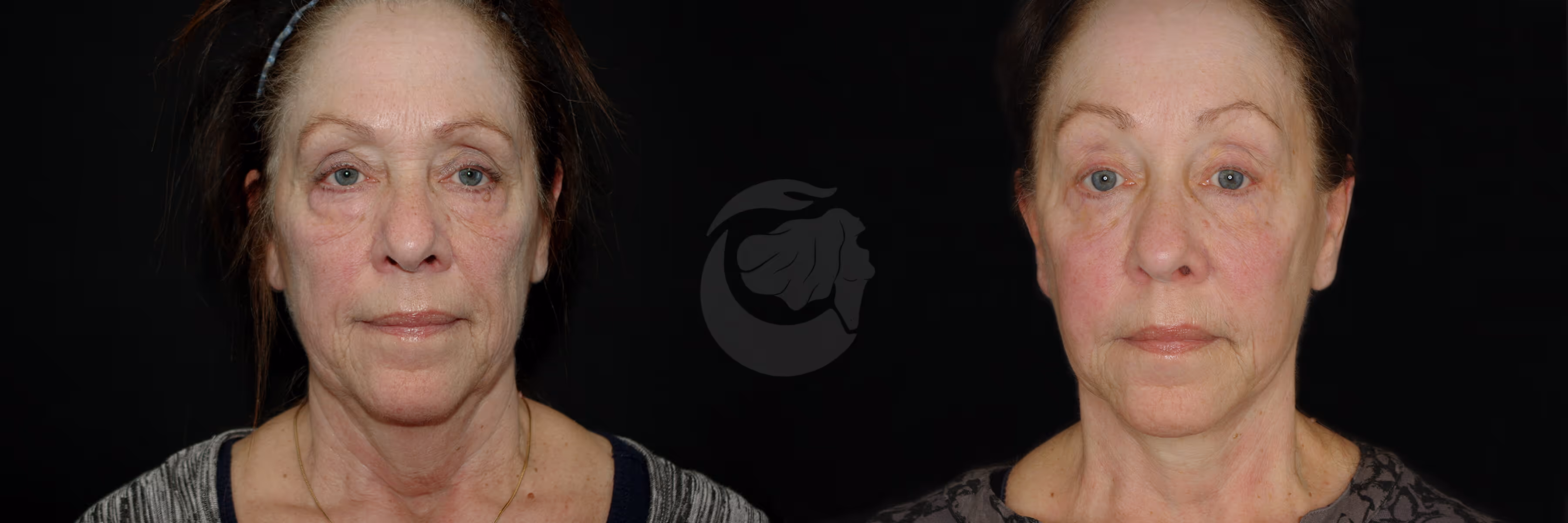 Before And After Patient Image