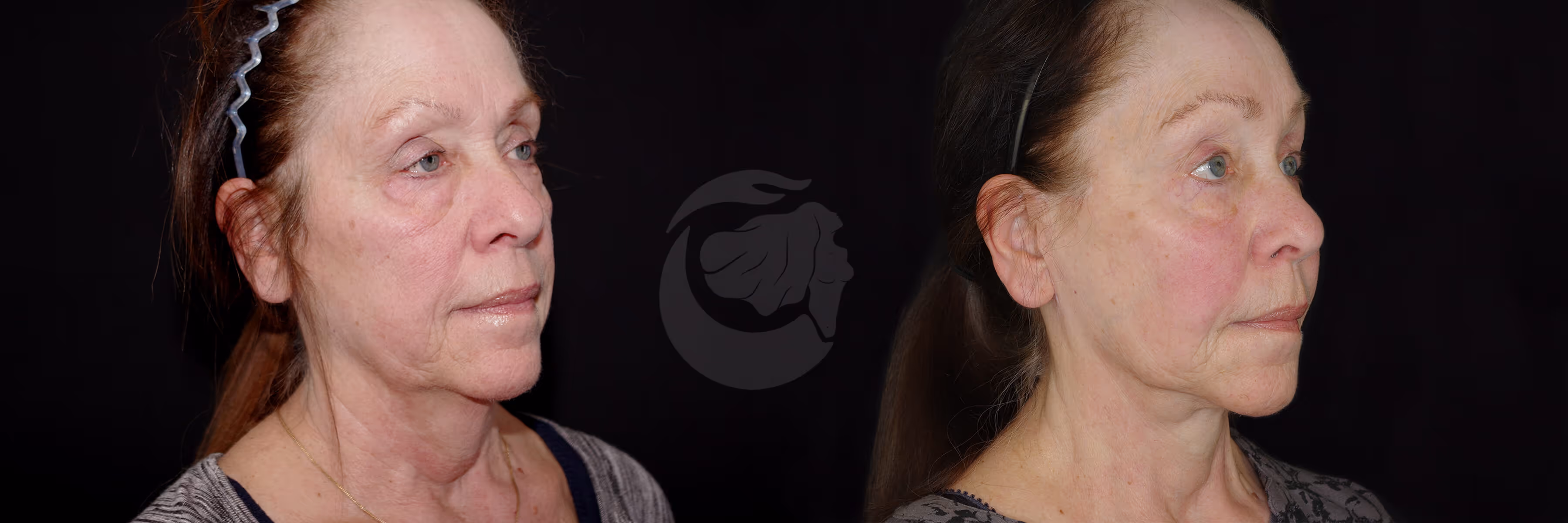 Before And After Patient Image