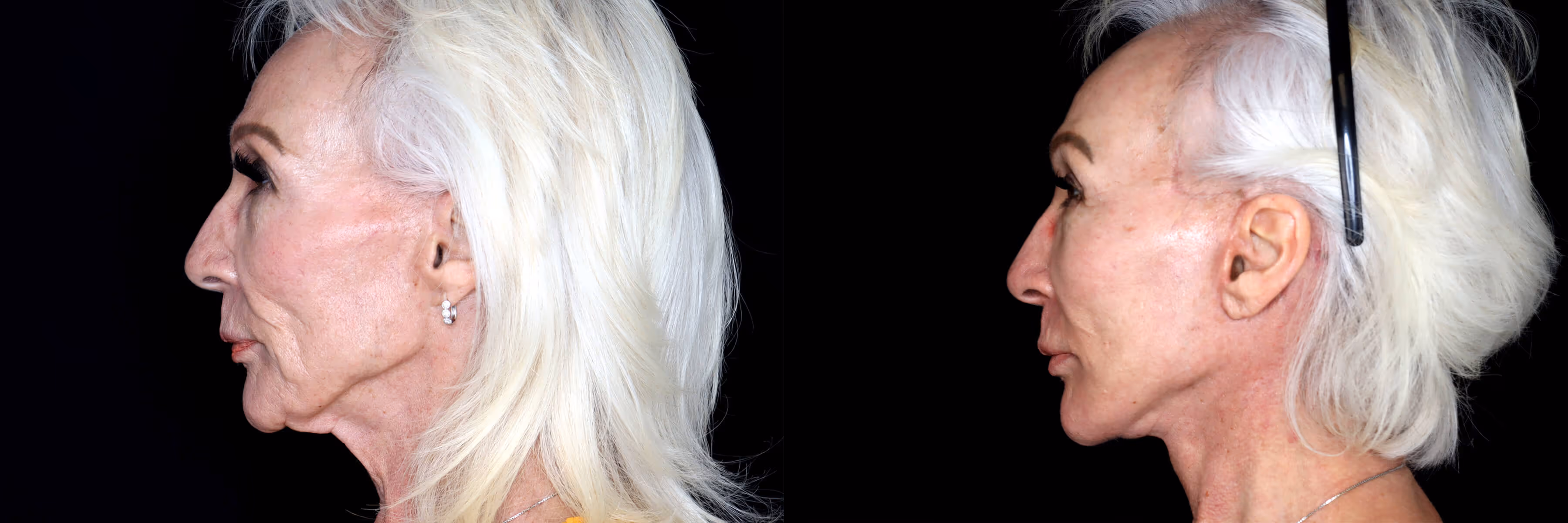 Before And After Patient Image