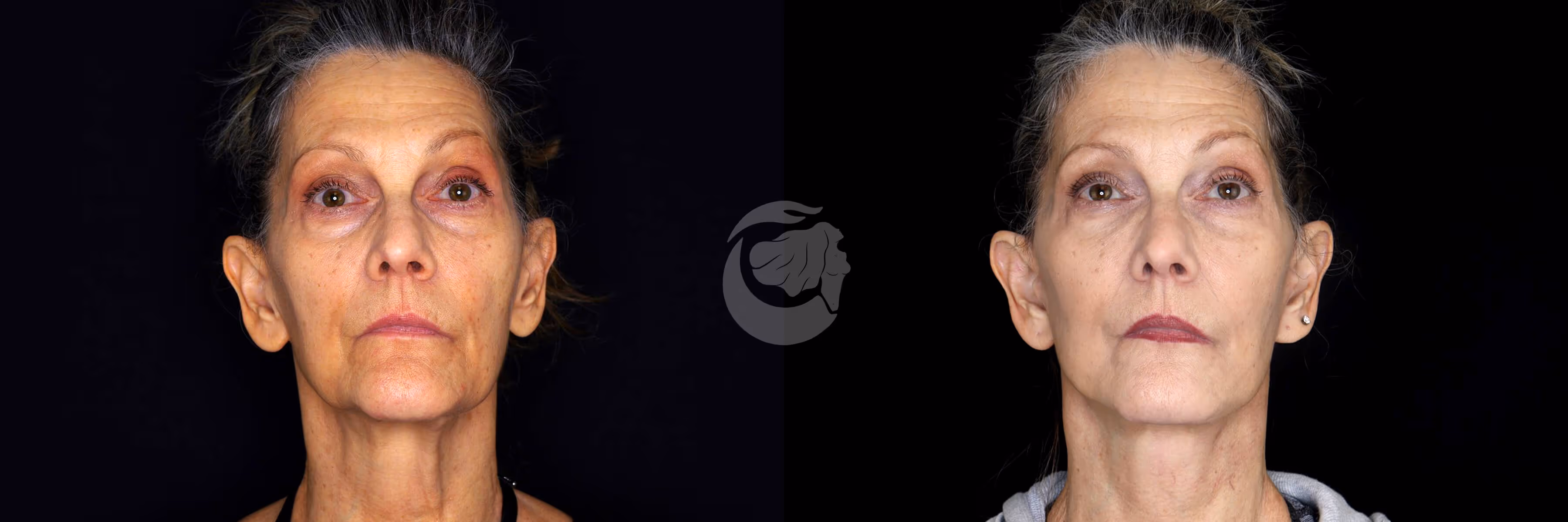 Before And After Patient Image