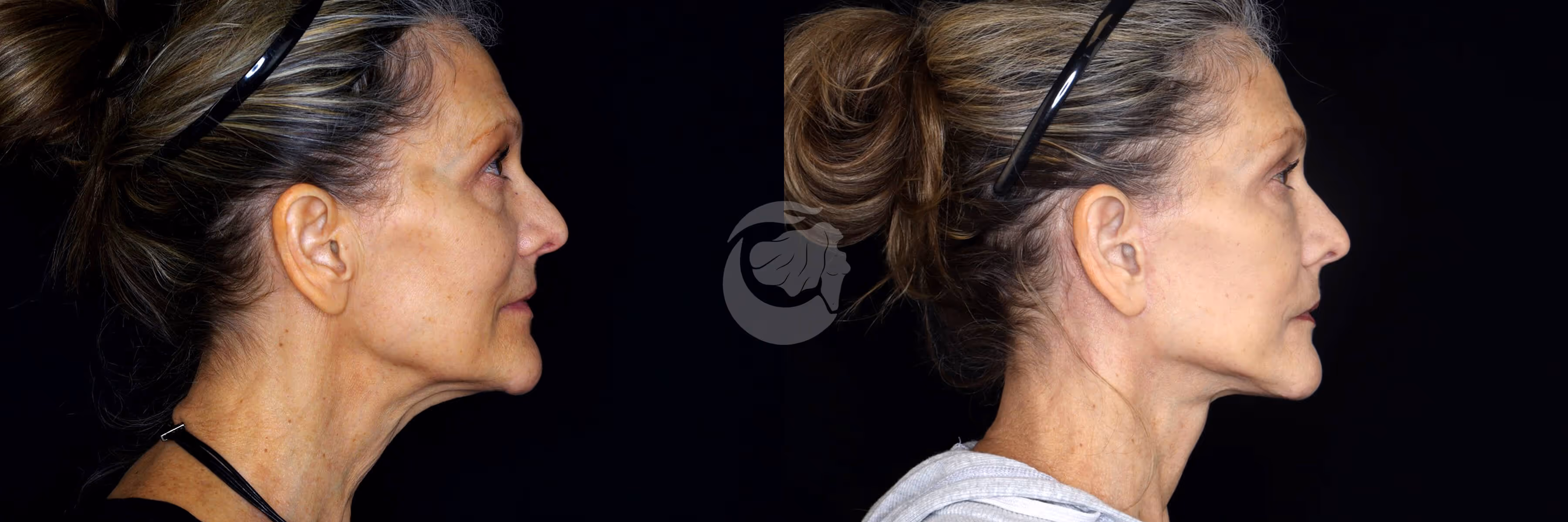 Before And After Patient Image