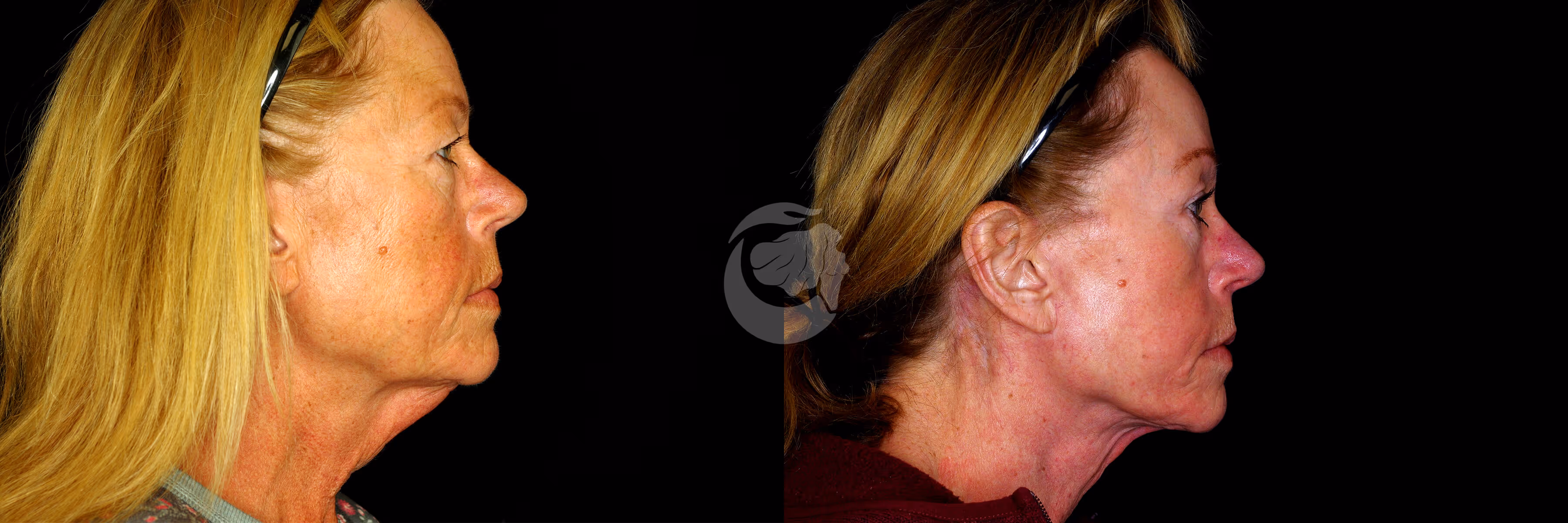 Before And After Patient Image