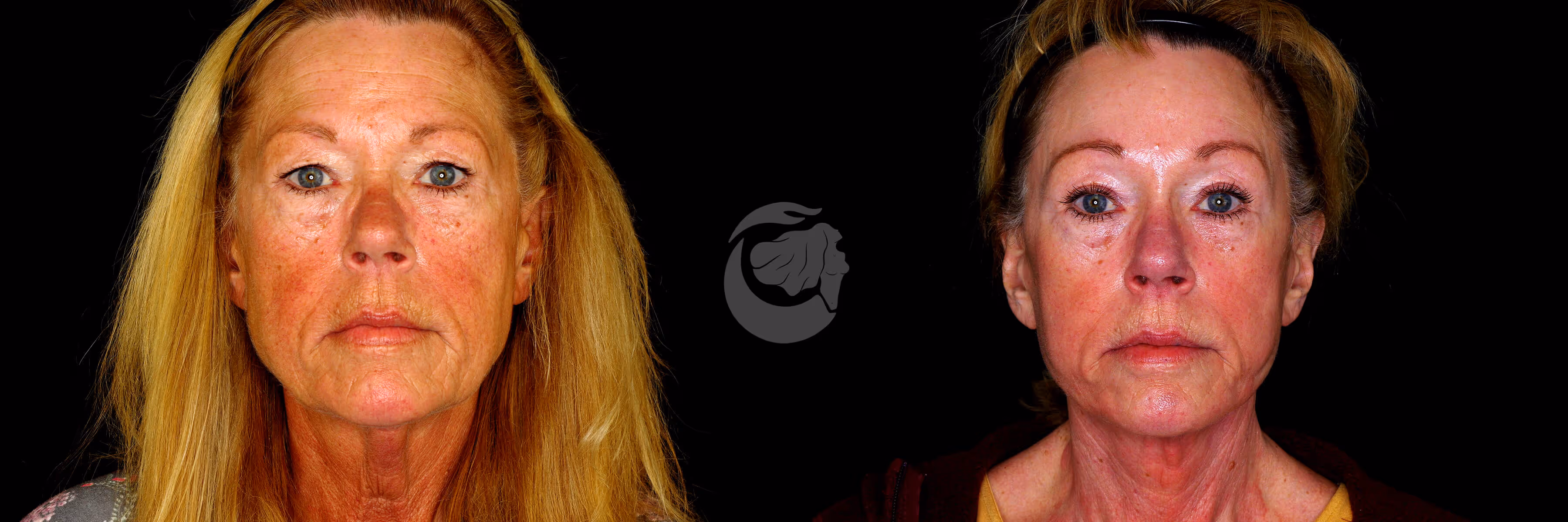 Before And After Patient Image