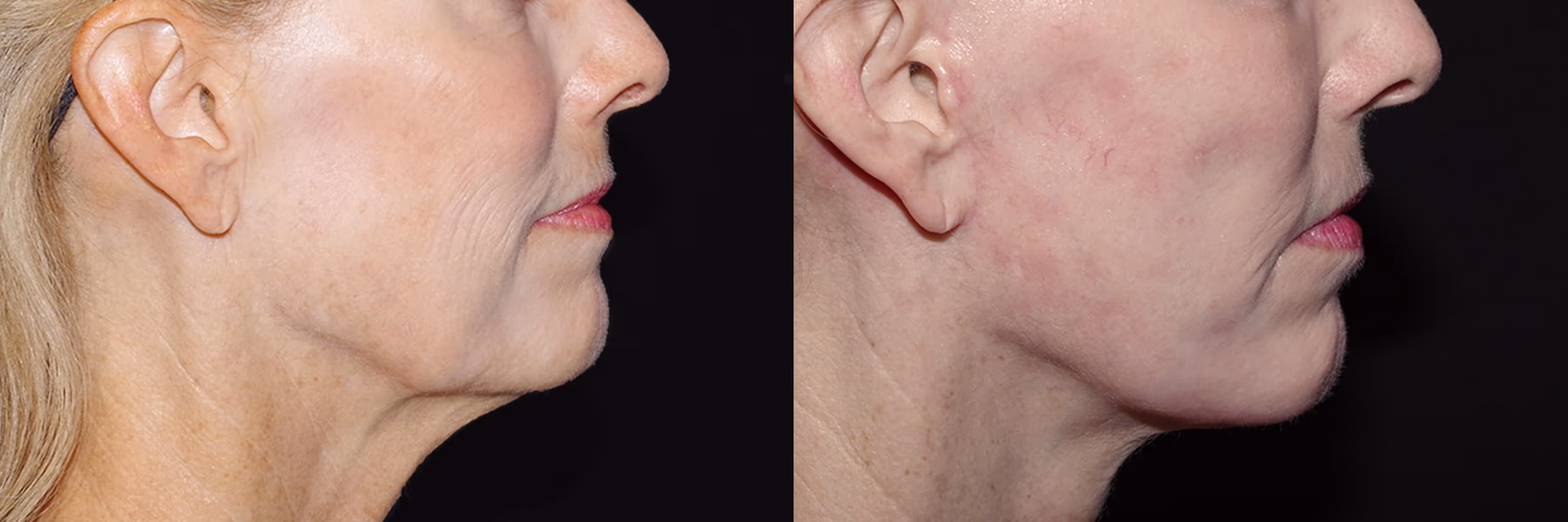 Before And After Patient Image
