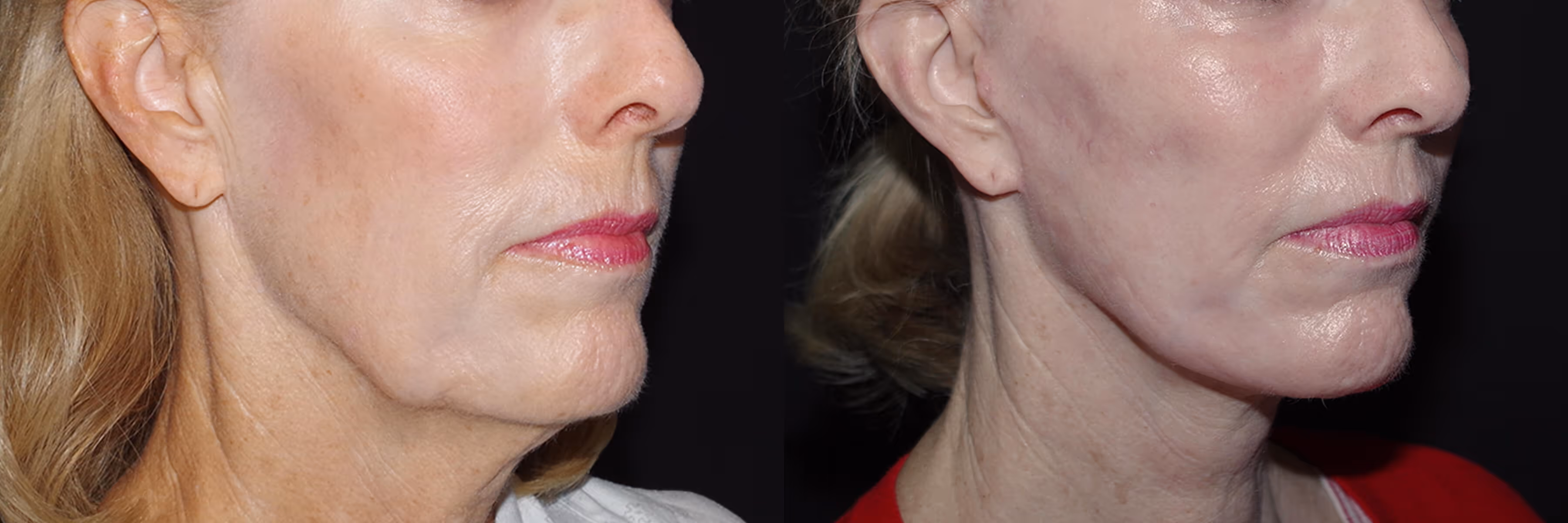 Before And After Patient Image