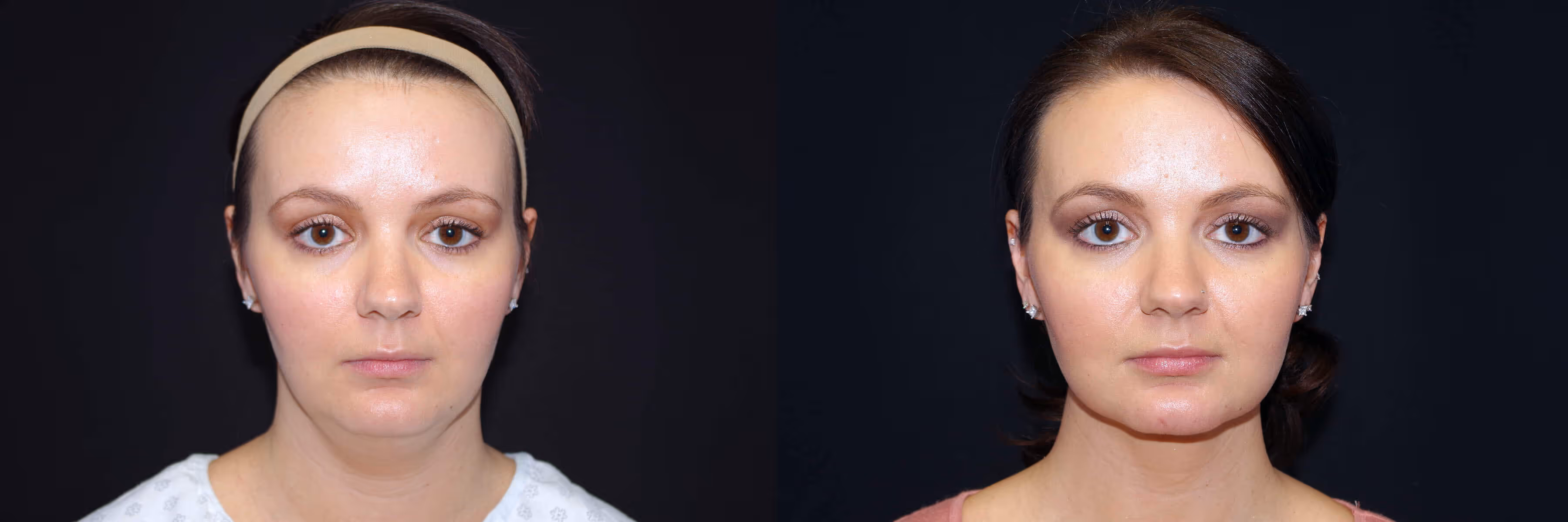 Before And After Patient Image
