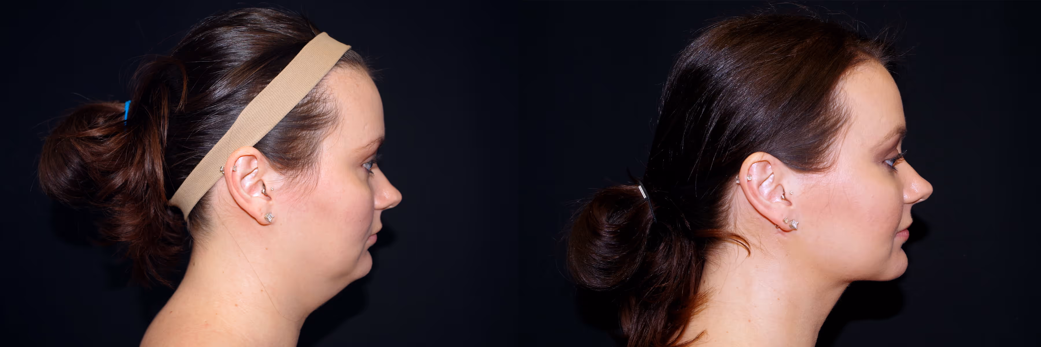 Before And After Patient Image