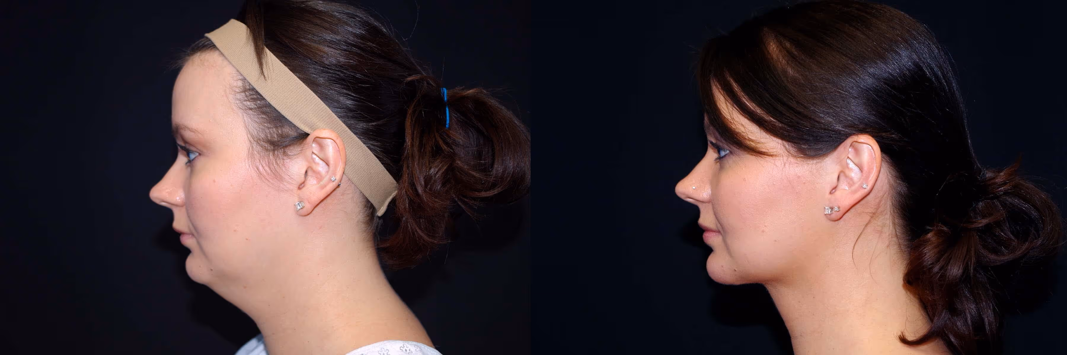 Before And After Patient Image