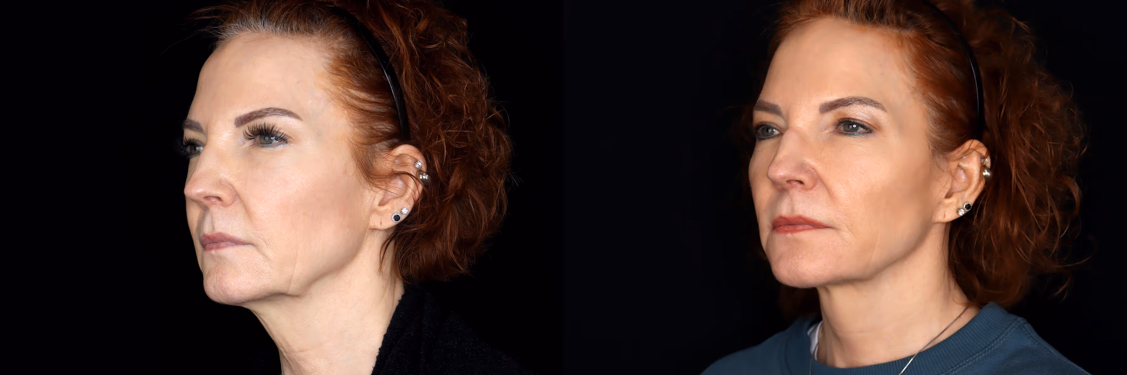 Before And After Patient Image