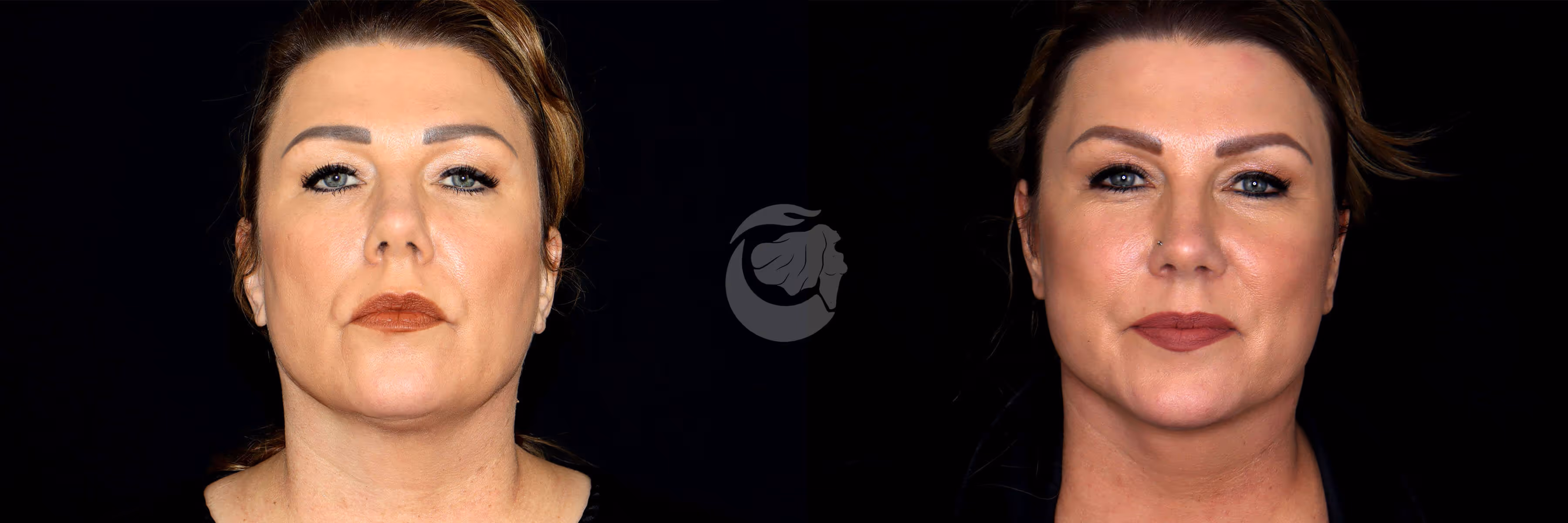 Before And After Patient Image
