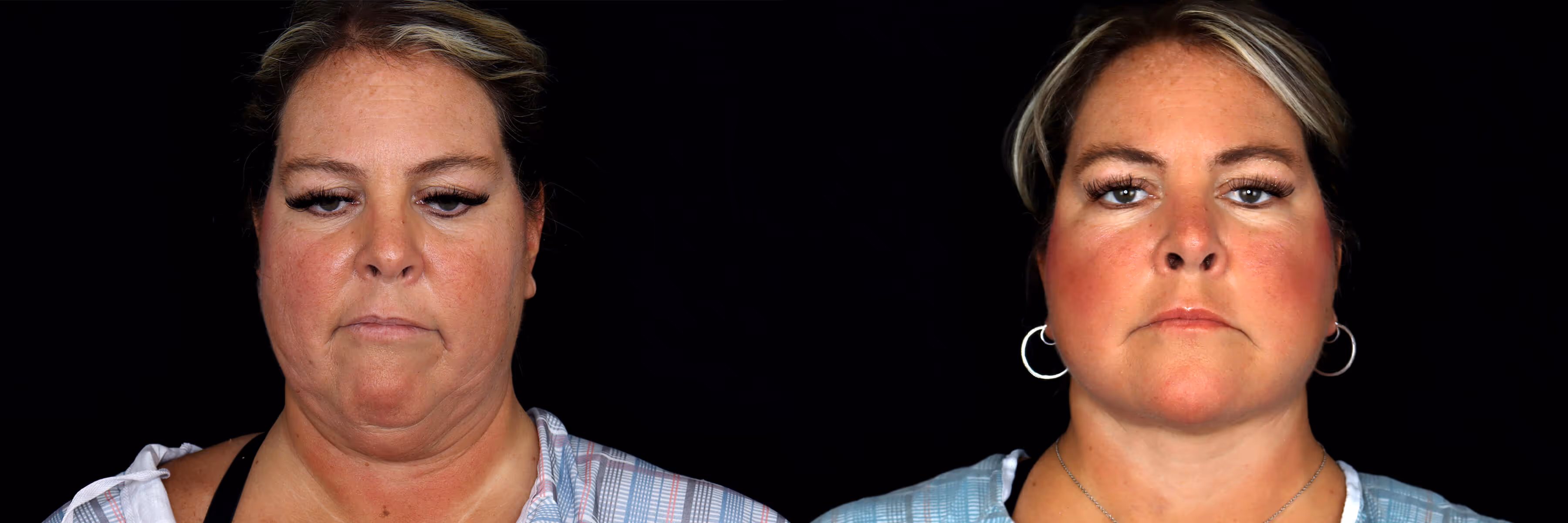 Before And After Patient Image