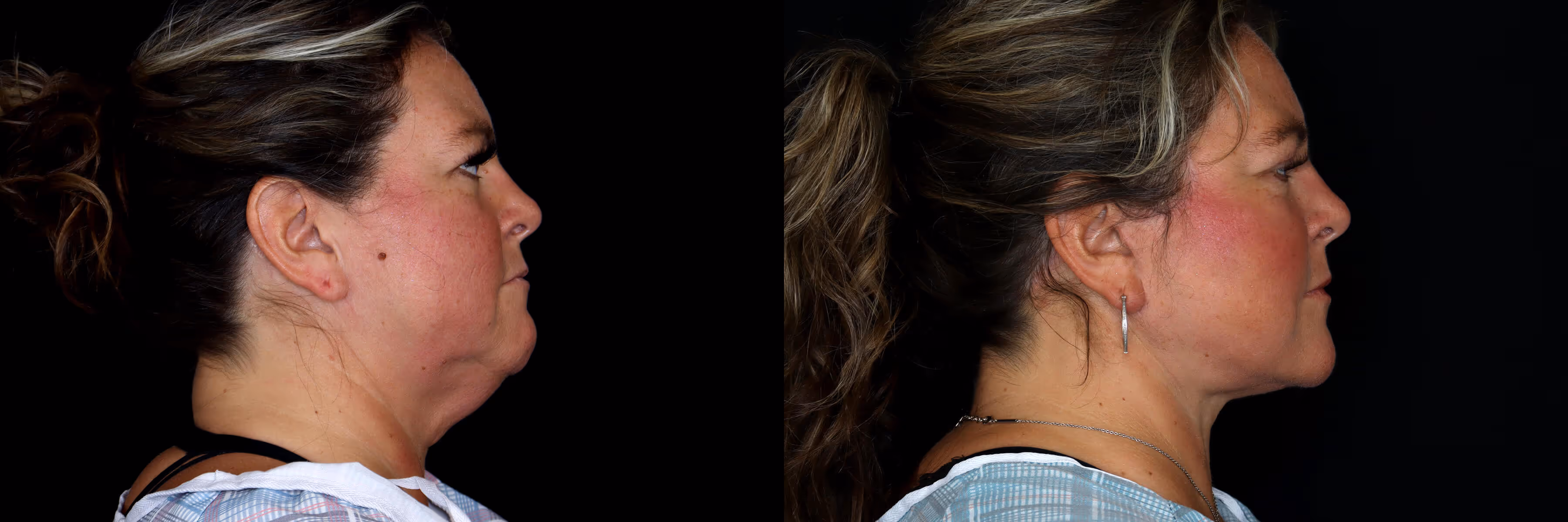 Before And After Patient Image