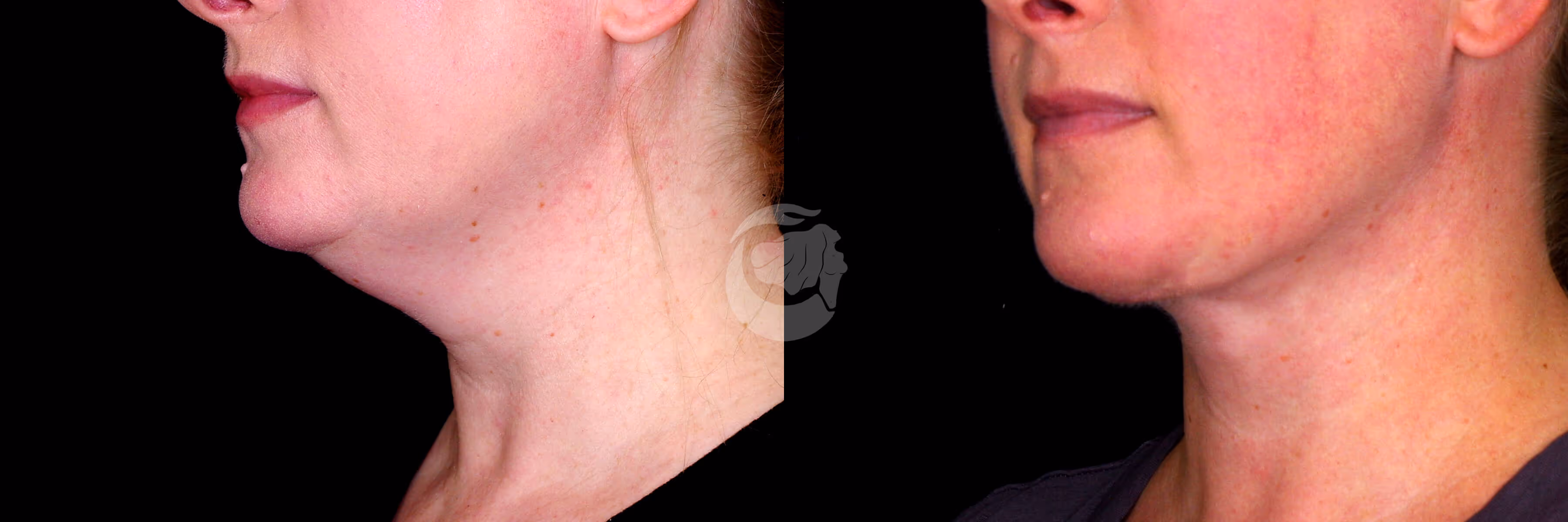 Before And After Patient Image