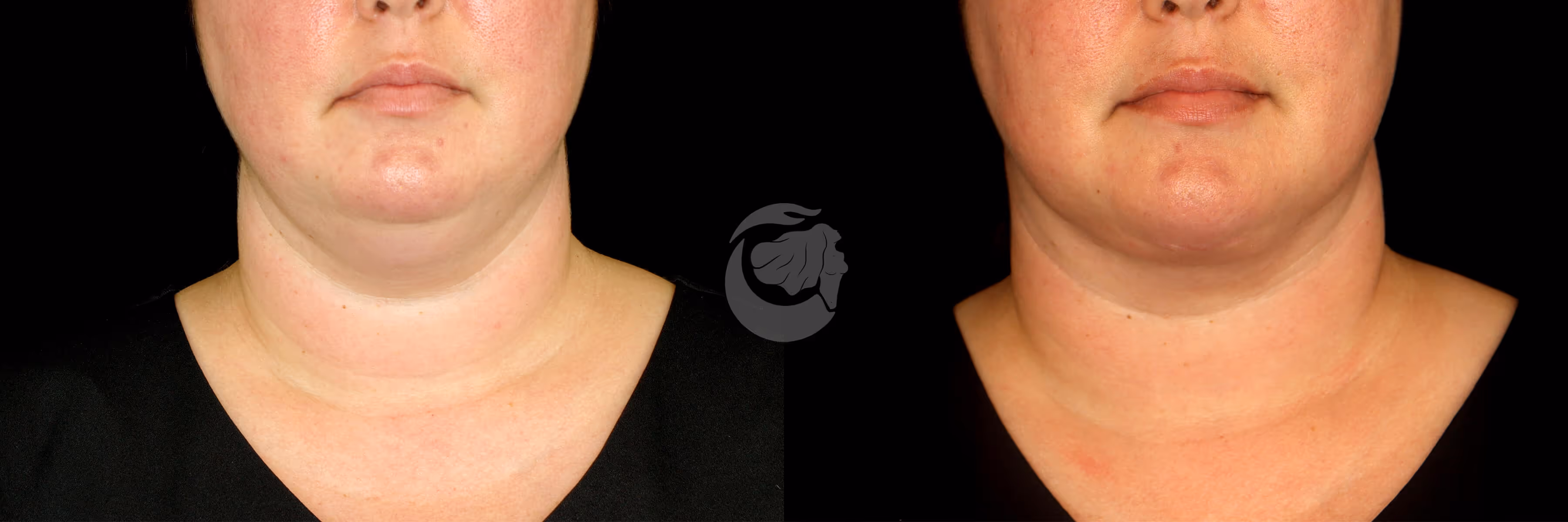 Before And After Patient Image