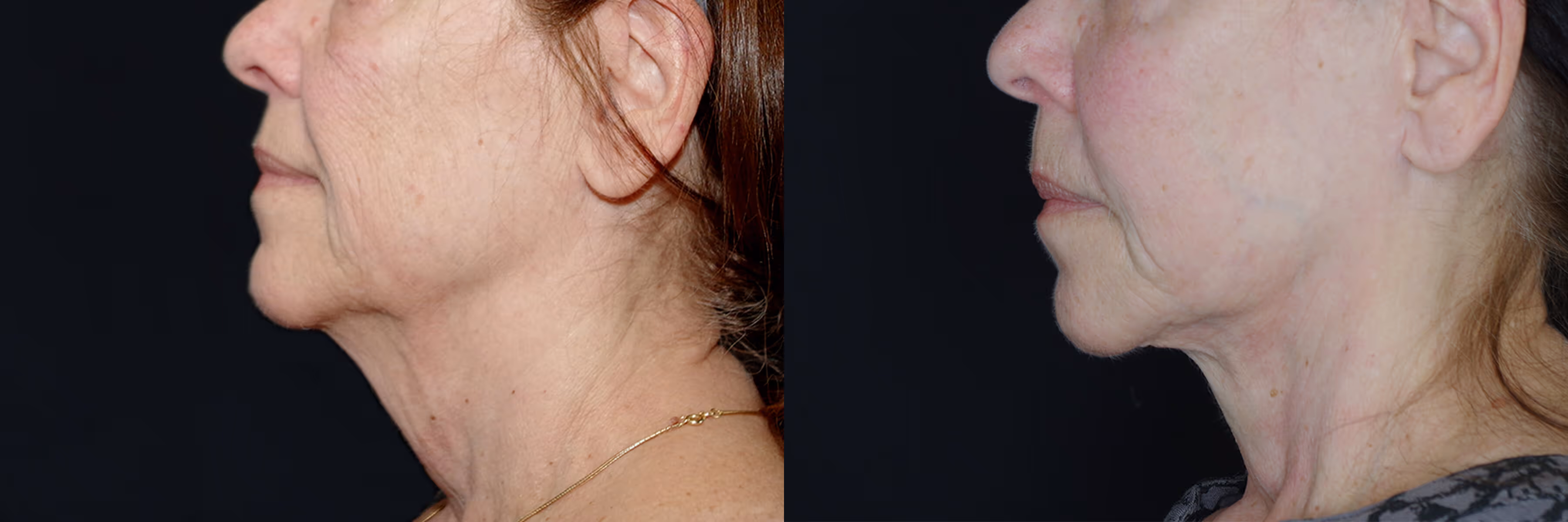 Before And After Patient Image