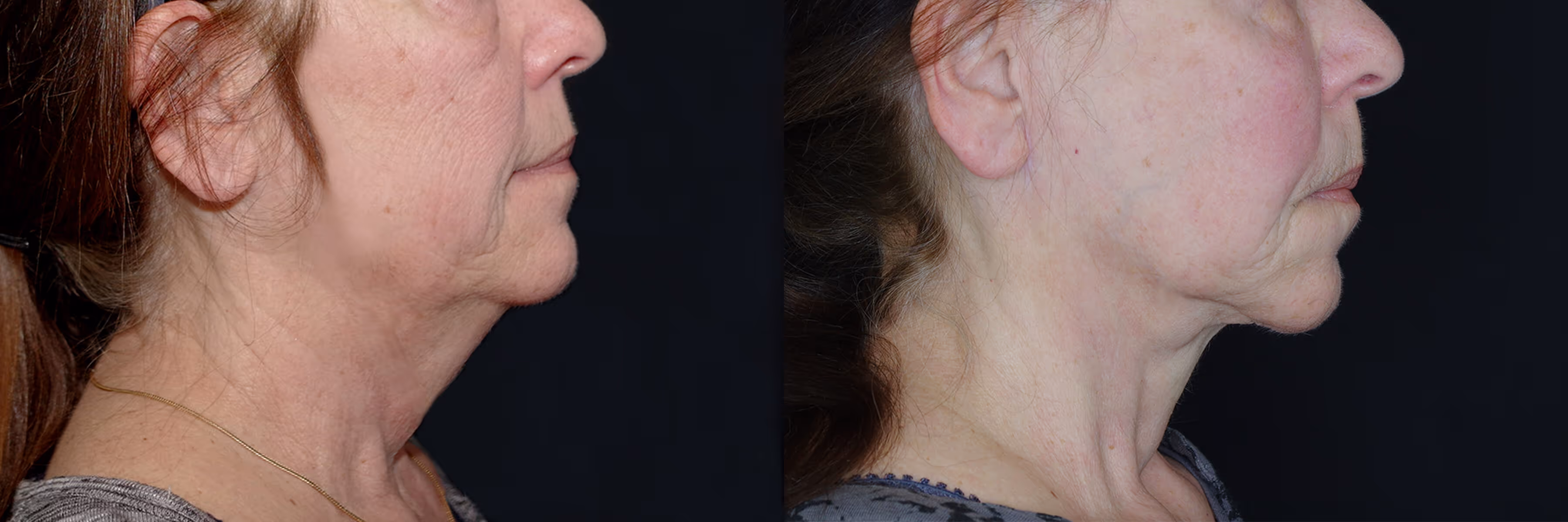 Before And After Patient Image