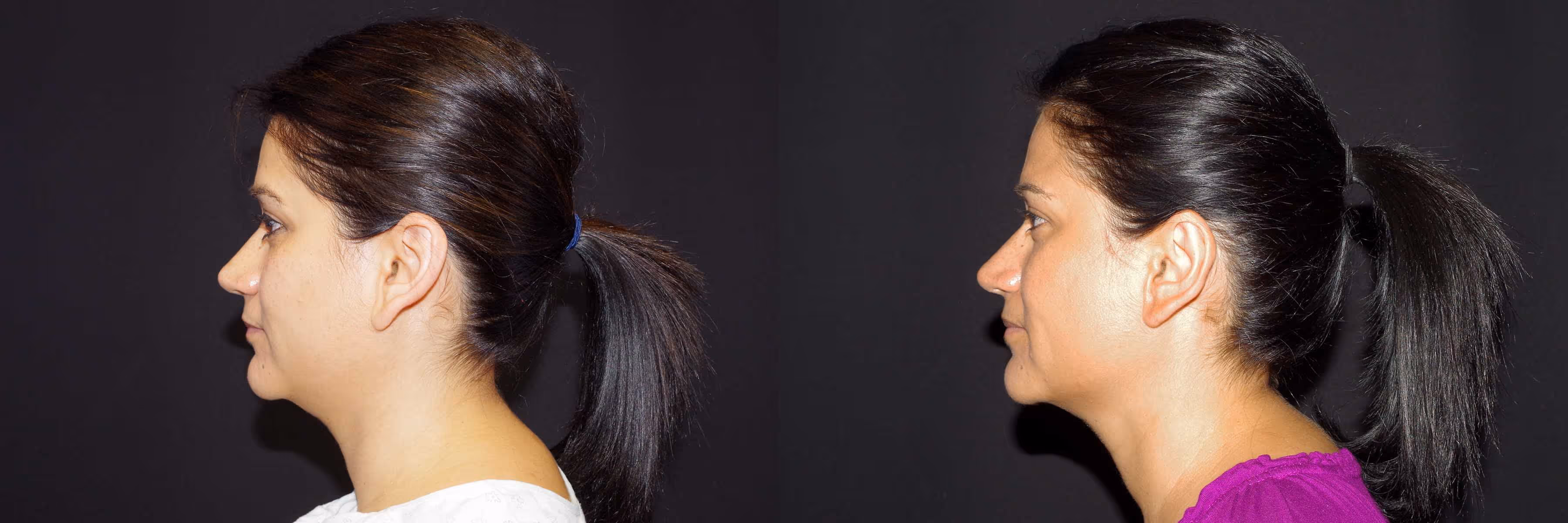 Before And After Patient Image