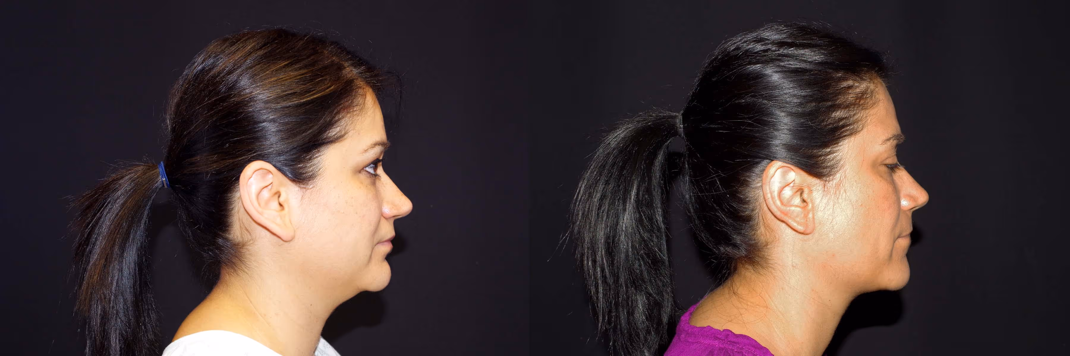 Before And After Patient Image
