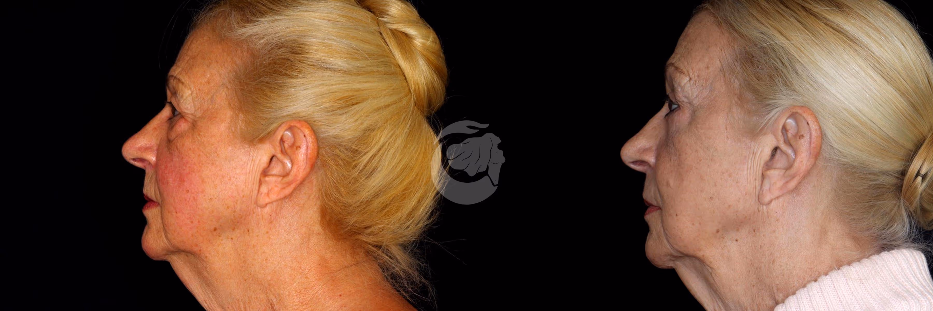 Before And After Patient Image