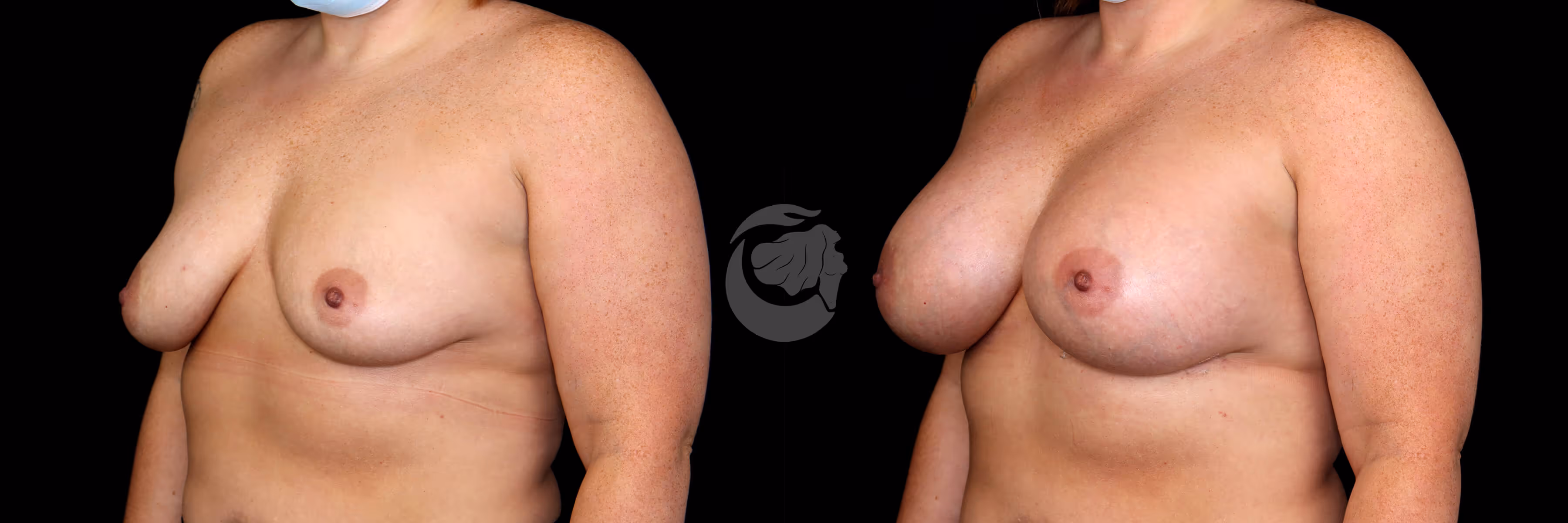 Before And After Patient Image