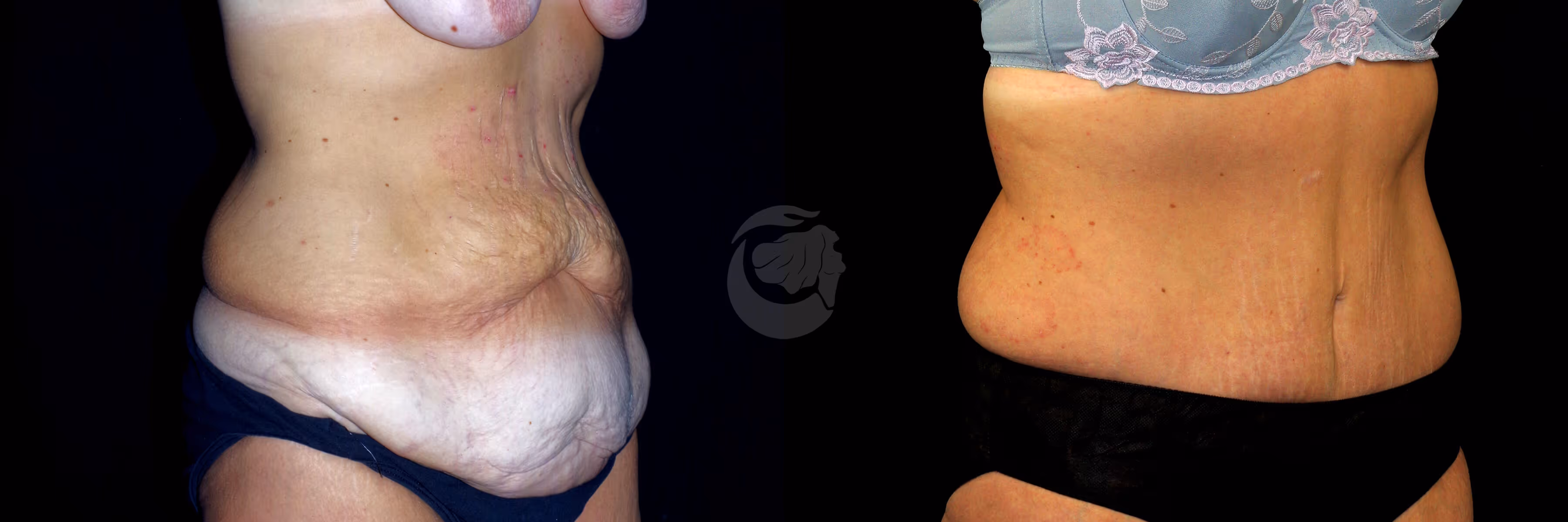 Before And After Patient Image