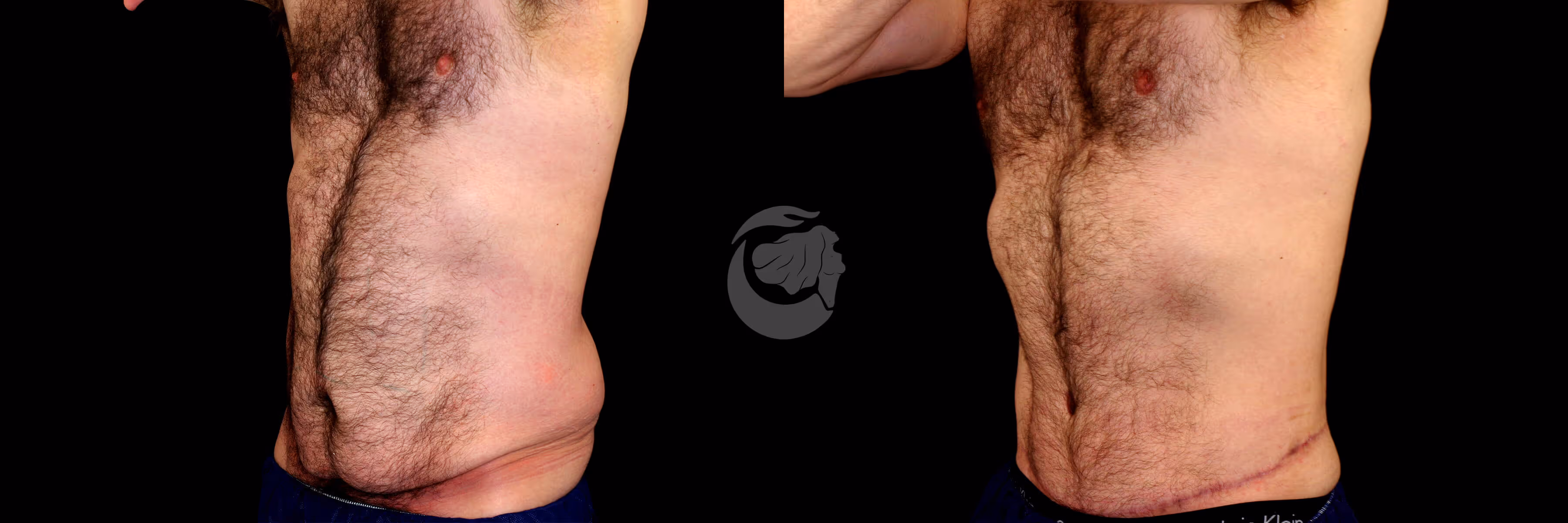Before And After Patient Image
