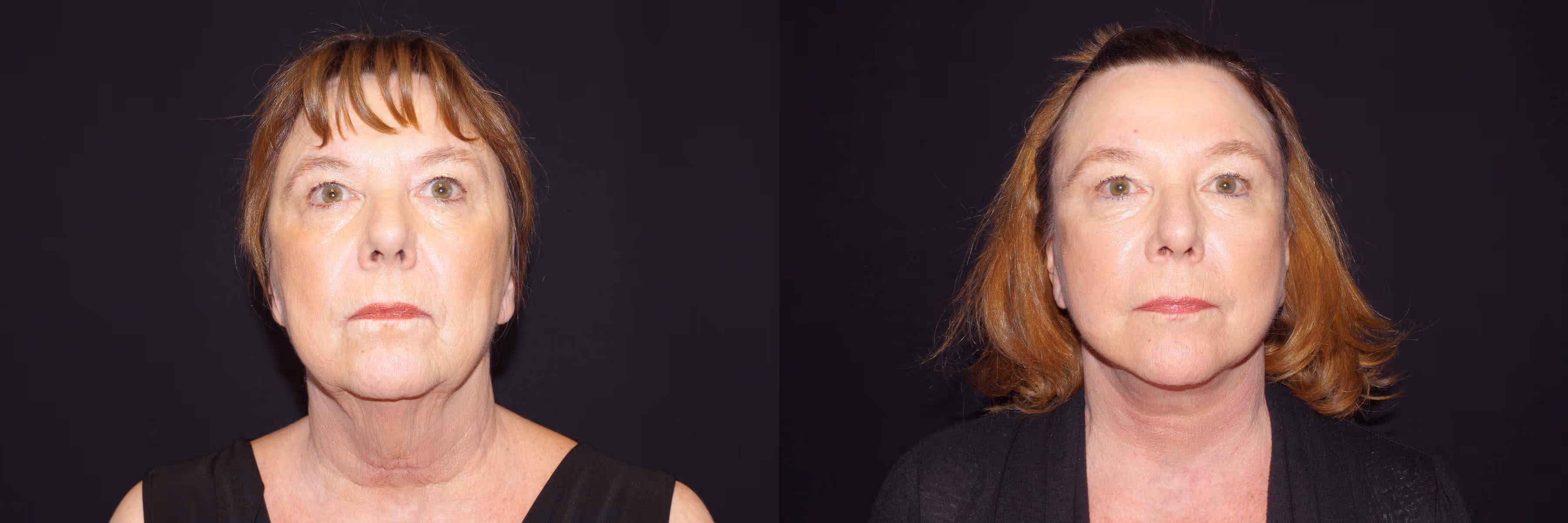Before And After Patient Image
