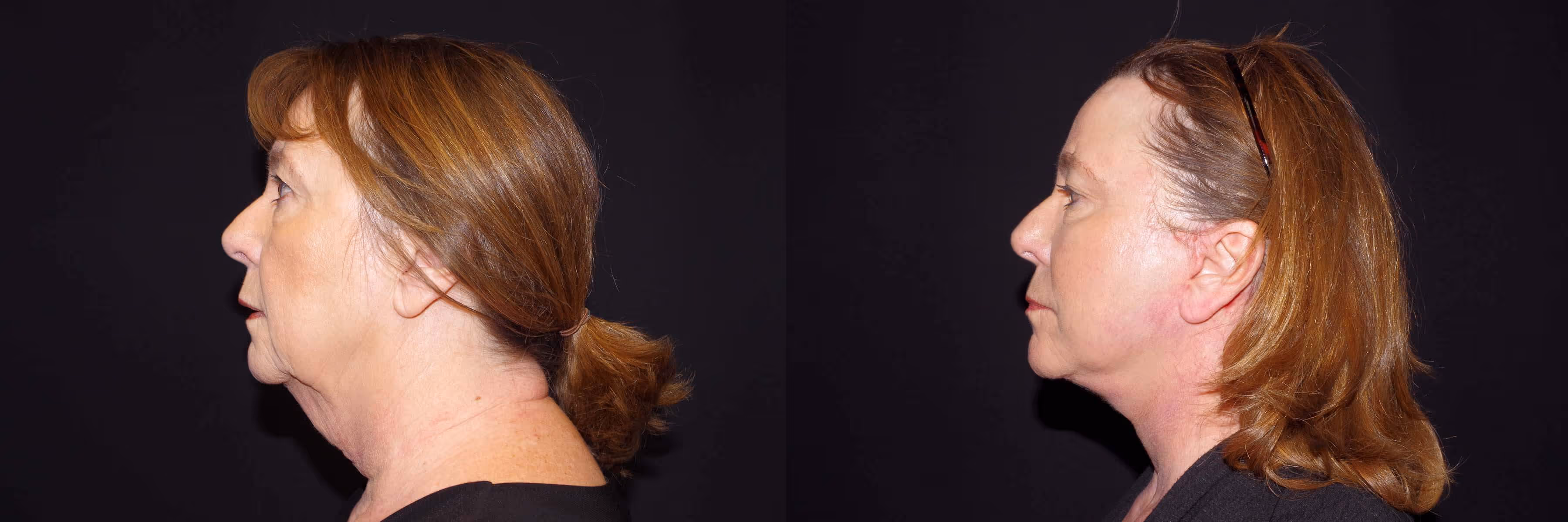 Before And After Patient Image