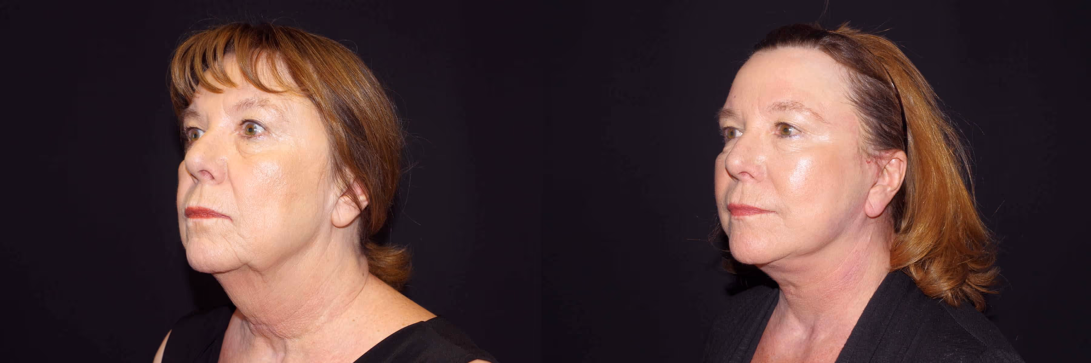 Before And After Patient Image