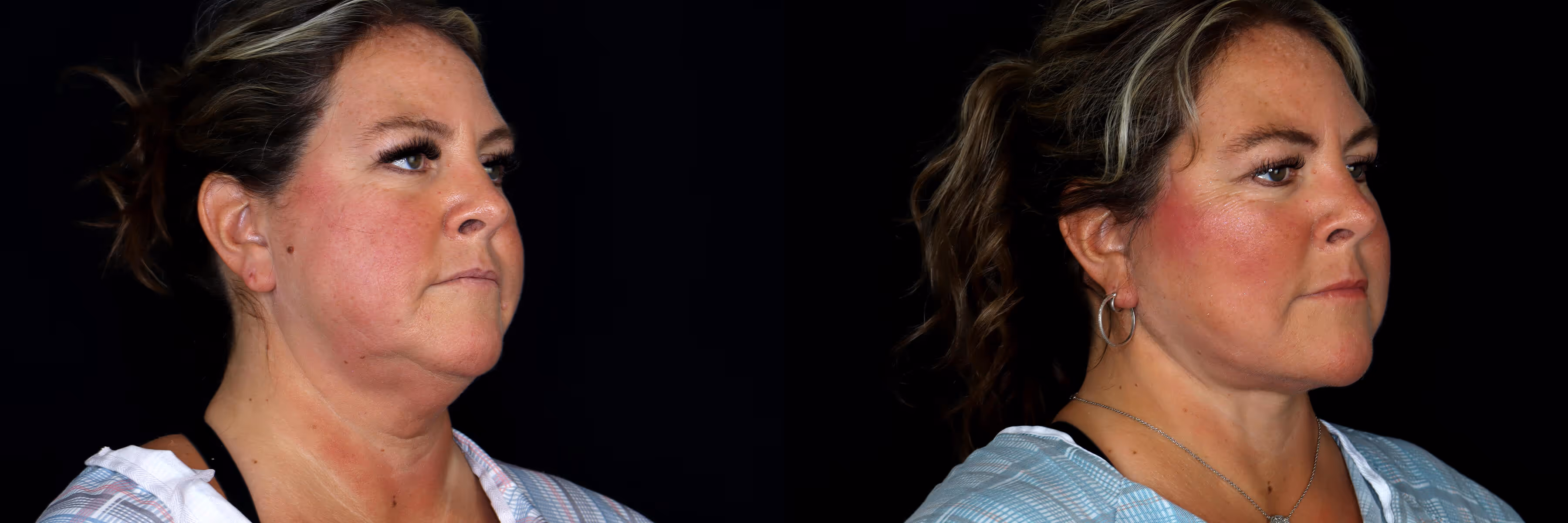 Before And After Patient Image