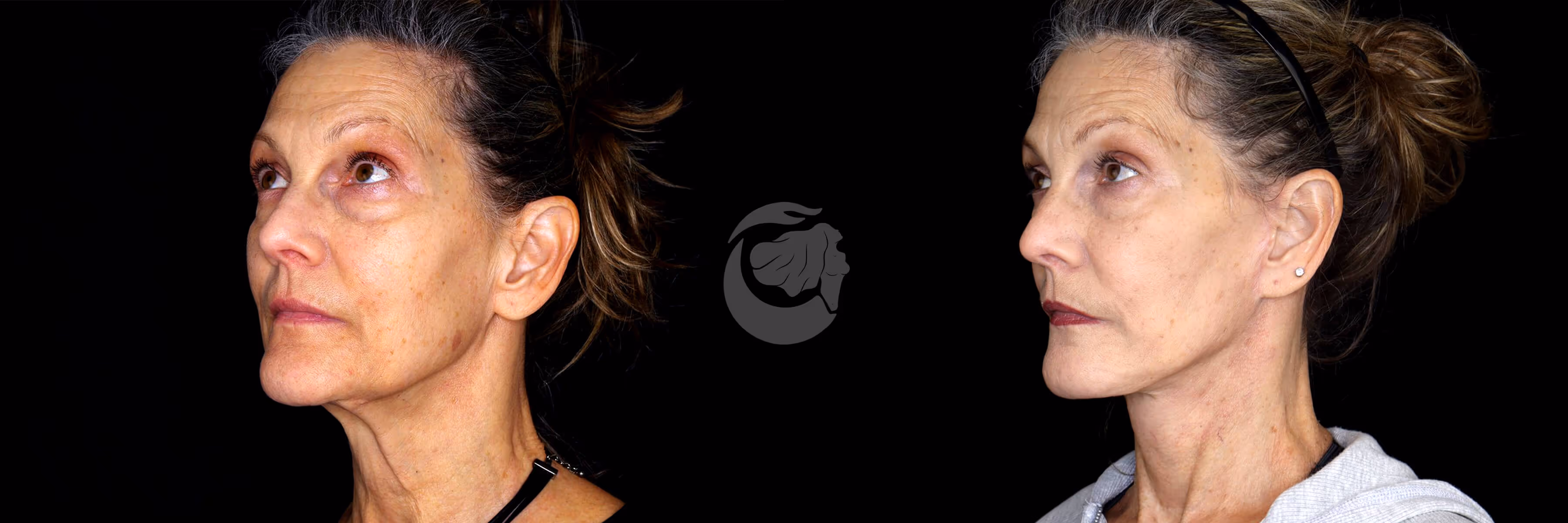 Before And After Patient Image