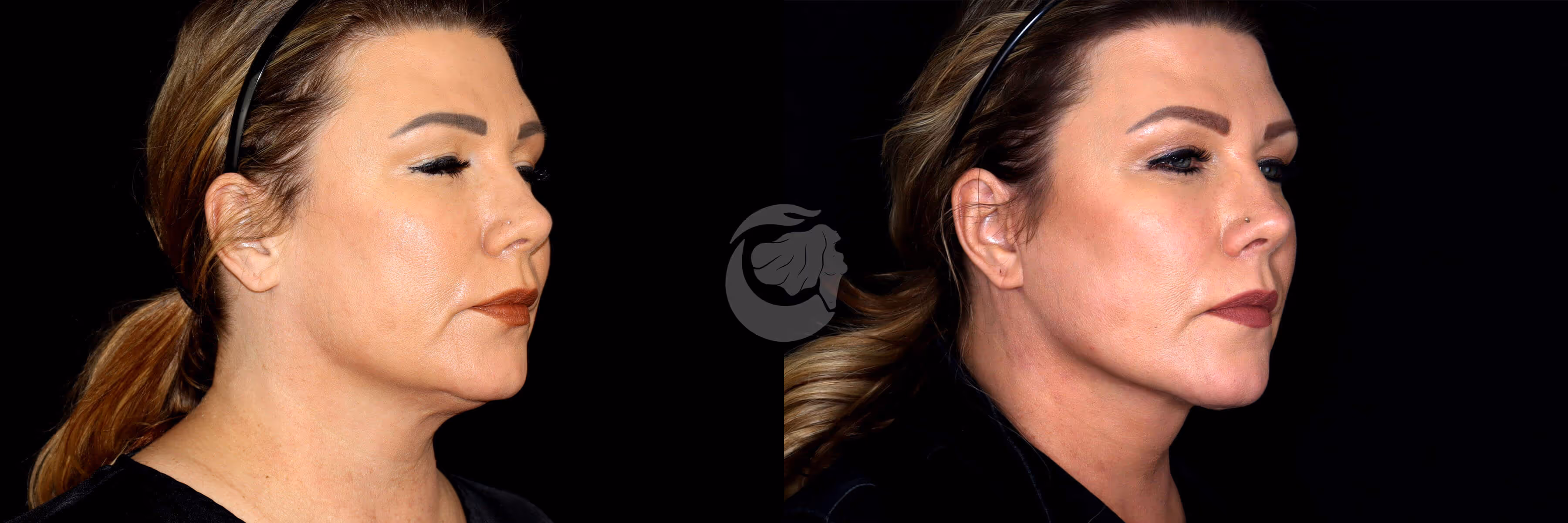Before And After Patient Image