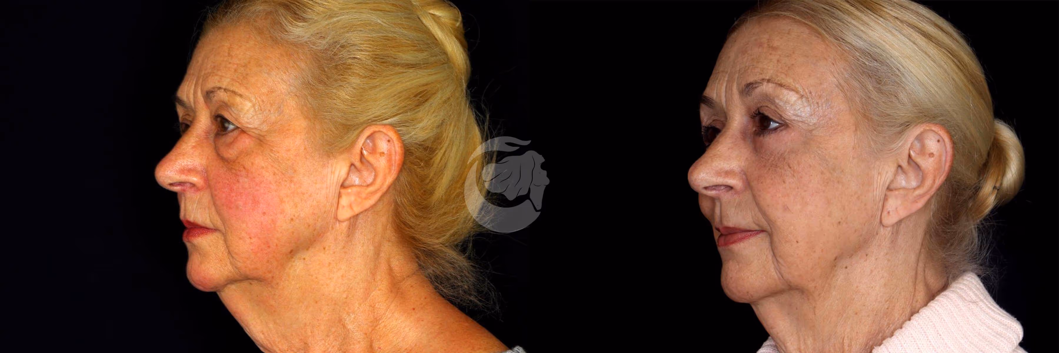 Before And After Patient Image