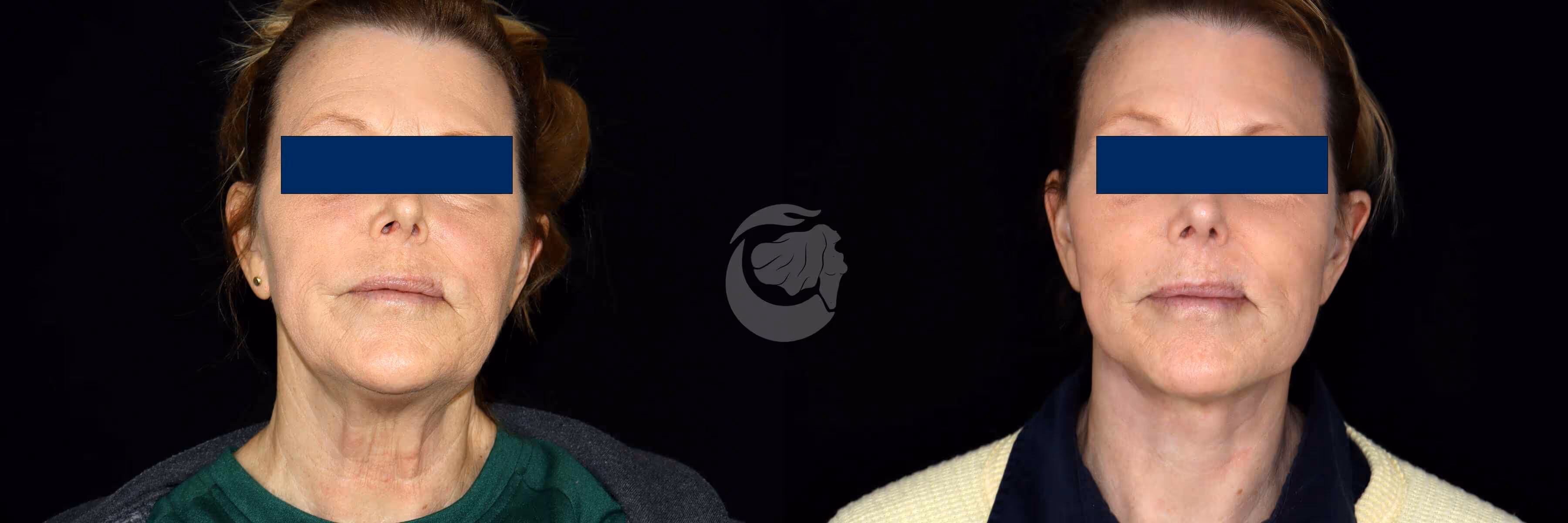 Before And After Patient Image